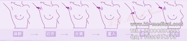 韩国隆胸,韩国假体隆胸,韩国隆胸假体,韩国隆胸方法,韩国整形医院