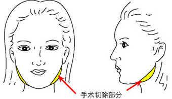 磨骨整形,韩国磨骨整形,磨骨手术,韩国整容,韩国面部整形
