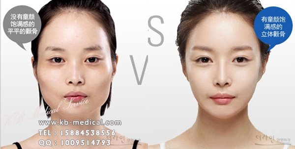 韩国整形前后对比图 韩国改脸型手术前后对比照片