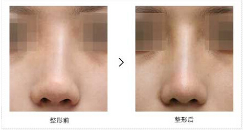赴韩整形,韩国整形,假体隆鼻