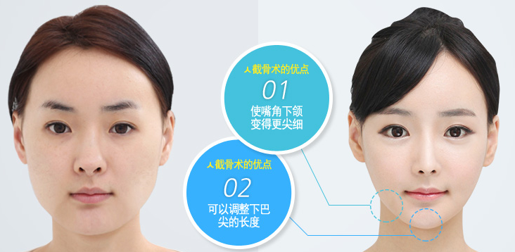倒v形截骨