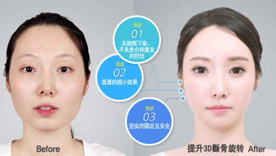 3d颧骨旋转术