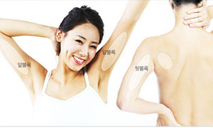 手臂吸脂效果图