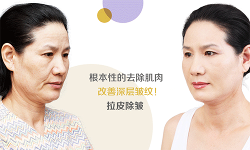 脸部拉皮除皱