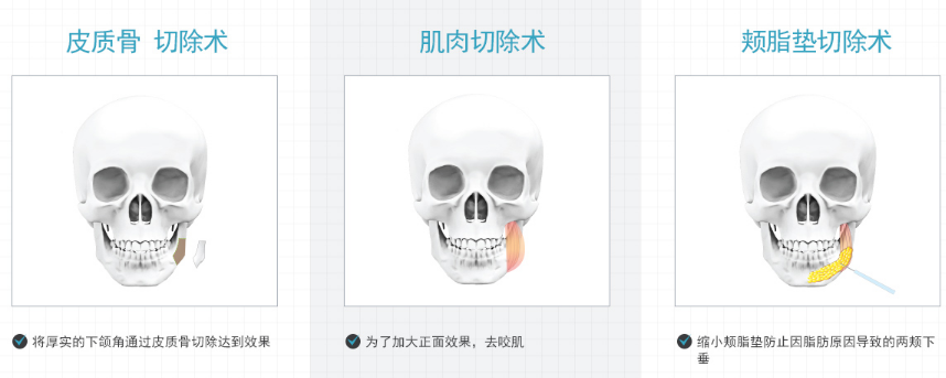 韩国下颌角整形搭配项目