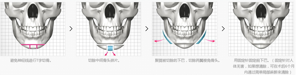 下巴整形过程