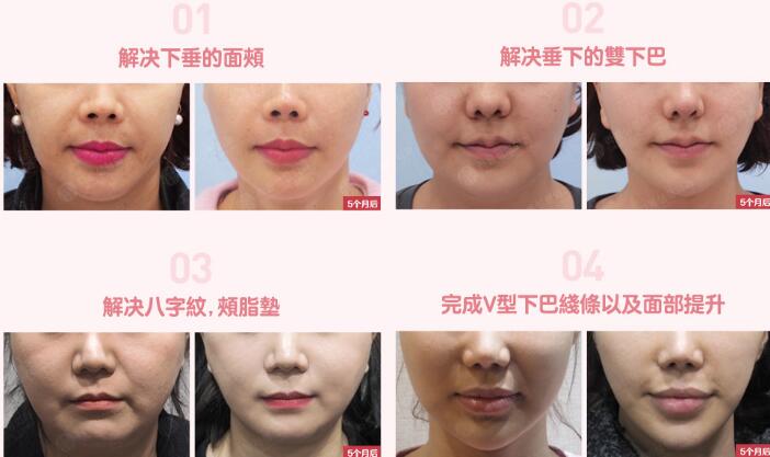 面部提升手术效果