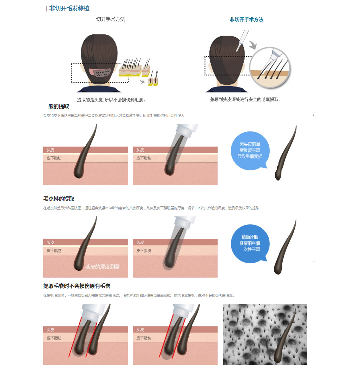 【盘点】FUT有痕头发种植和FUE微创植发技术哪里截然不同？_千颜网
