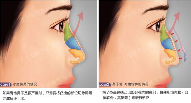 鹰钩鼻矫正方法图片图片