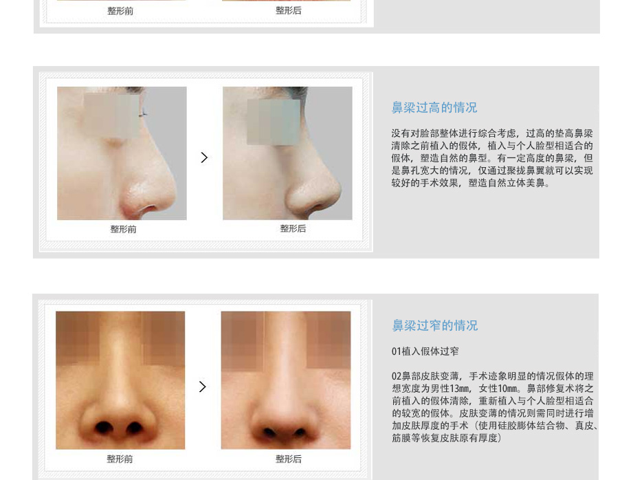 鼻部整形修复,鼻部整形失败修复,韩国鼻部整形,韩国整形医院,