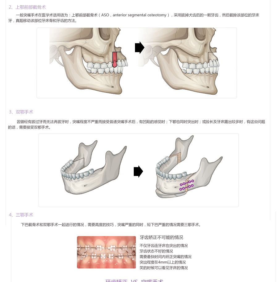 双鄂手术,双鄂手术,韩国双颚手术,双鄂手术价格,两鄂手术,双颚手术前后