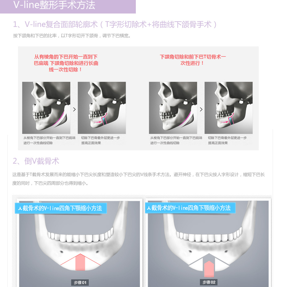 V-line整形手术,韩国V-line手术,v-line小脸术,改脸型,面部轮廓整形