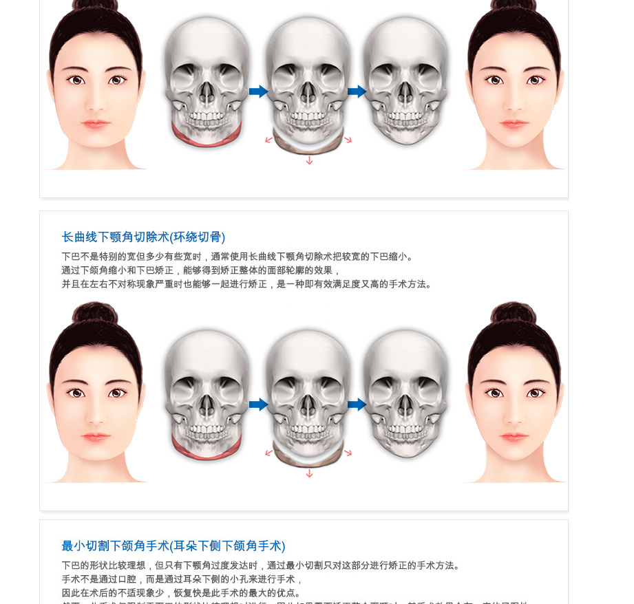 下颌角整形,下颌角整形术,韩国下颌角整形,下颌角整形价格,韩国整形