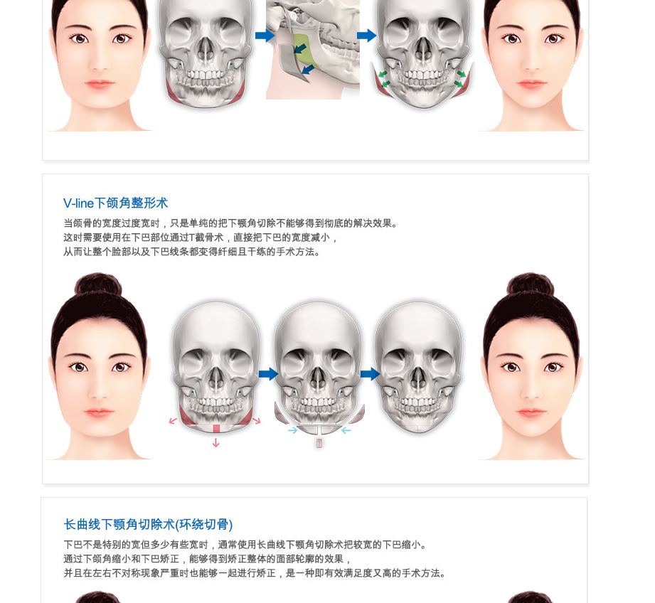 下颌角整形,下颌角整形术,韩国下颌角整形,下颌角整形价格,韩国整形