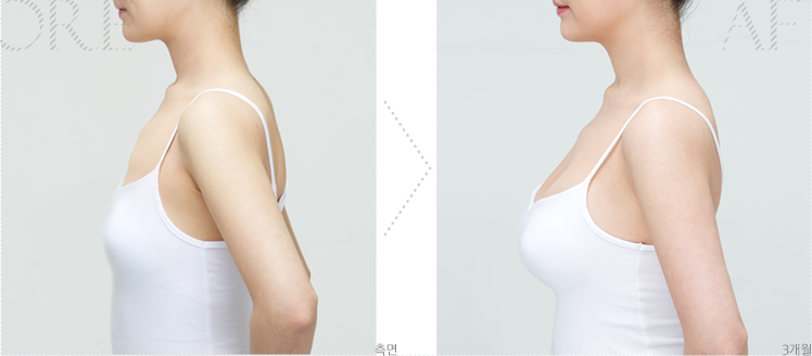 假体隆胸图片前后对比图片